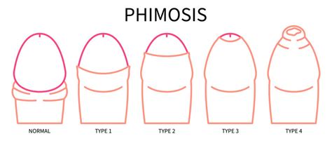 penis necircumcis|Photo Gallery: Circumcised vs Uncircumcised